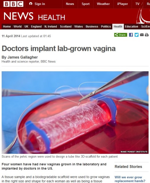 Doctor's Implant Lab-Grown Vagina